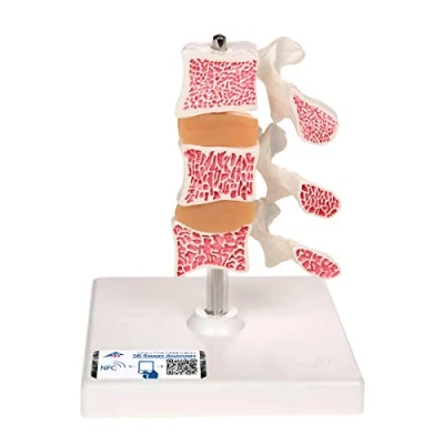 Image de 3B Scientific A78 Modèle d’Ostéoporose de Luxe, 3 Vertèbres + Application anatomie gratuite Smart Anatomy